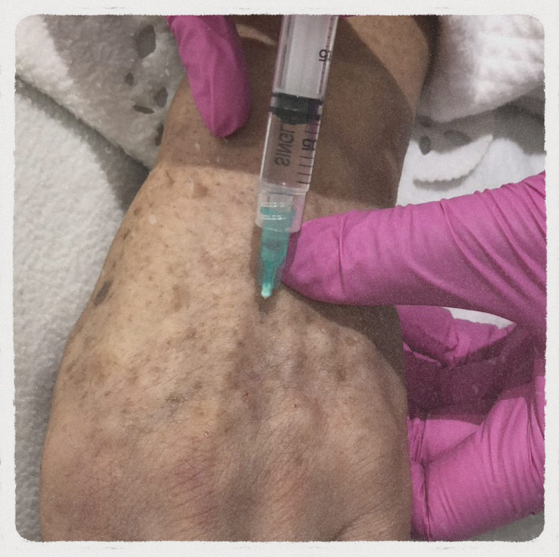 ANTI-AGING Hands with PRP and/or stem cell